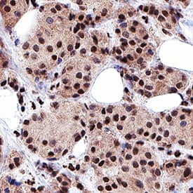 HMGB1/HMG-1 antibody in Human Breast Cancer Tissue by Immunohistochemistry (IHC-P).