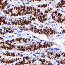 HNF-3a/FoxA1 antibody in Human Breast Cancer Tissue by Immunohistochemistry (IHC-P).
