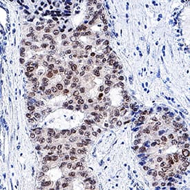 HNF-3 beta/FoxA2 antibody in Human Liver Cancer Tissue by Immunohistochemistry (IHC-P).