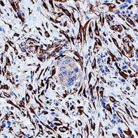HSP47 antibody in Human Breast Cancer Tissue by Immunohistochemistry (IHC-P).