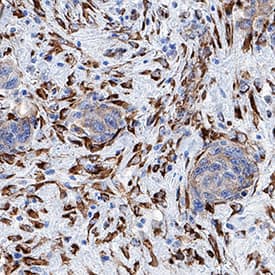 HSP47 antibody in Human Breast Cancer Tissue by Immunohistochemistry (IHC-P).