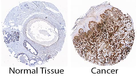 HSP47 antibody in Human Breast Cancer Tissue by Immunohistochemistry (IHC-P).