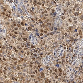 HSP70/HSPA1A antibody in Human Kidney Cancer Tissue by Immunohistochemistry (IHC-P).