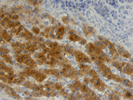 HSP70/HSPA1A antibody in Human Liver Cancer Tissue by Immunohistochemistry (IHC-P).