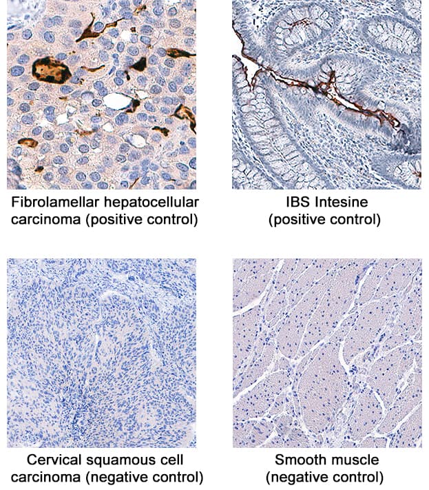 HTRA1/PRSS11 antibody in Human Hepatocellular Carcinoma and IBS Intestine by Immunohistochemistry (IHC-P).