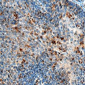 Hexokinase 1/2 antibody in Human Cervical Cancer Tissue by Immunohistochemistry (IHC-P).