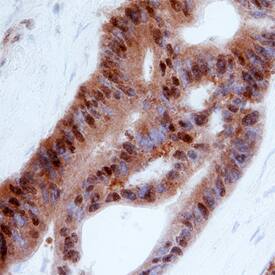 ICAP-1 antibody in Human Colon Cancer Tissue by Immunohistochemistry (IHC-P).