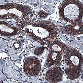 ICAT antibody in Human Fibrocystic Breast Tissue by Immunohistochemistry (IHC-P).