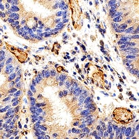 IGFBP-rp1/IGFBP-7 antibody in Human Colon Cancer Tissue by Immunohistochemistry (IHC-P).