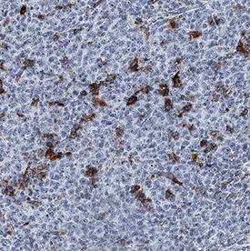 IL-4I1 antibody in Human B Cell Lymphoma by Immunohistochemistry (IHC-P).