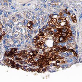 IRS1 antibody in Human Liver Cancer Tissue by Immunohistochemistry (IHC-P).