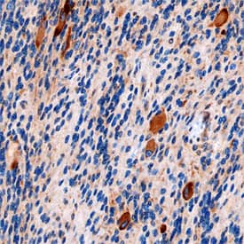 IkB-e antibody in Human Astrocytoma by Immunohistochemistry (IHC-P).