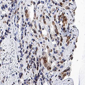 IkB-a antibody in Human Prostate Cancer Tissue by Immunohistochemistry (IHC-P).