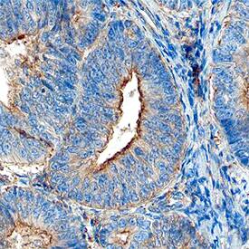 JAM-A antibody in Human Endometrial Cancer Tissue by Immunohistochemistry (IHC-P).