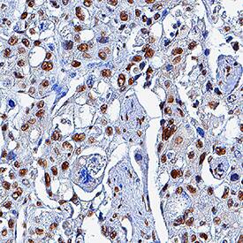 KAP1 antibody in Human Liver Cancer Tissue by Immunohistochemistry (IHC-P).
