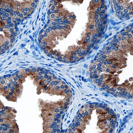 Kallikrein 3/PSA antibody in Prostate Cancer by Immunohistochemistry (IHC-P).