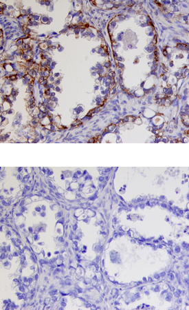 Kallikrein 9 antibody in Human Ovarian Cancer Tissue by Immunohistochemistry (IHC-P).