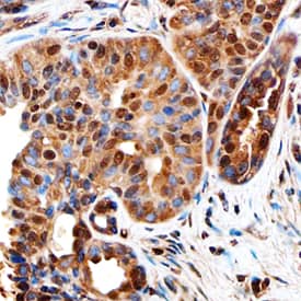 Ki67/MKI67 antibody in Human Breast Cancer Tissue by Immunohistochemistry (IHC-P).