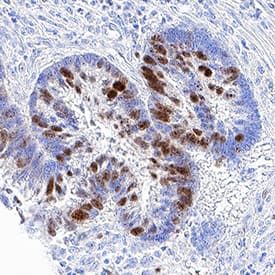 Ki67/MKI67 antibody in Human Pancreatic Cancer Tissue by Immunohistochemistry (IHC-P).