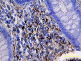 Kremen-1 antibody in Human Colon Cancer Tissue by Immunohistochemistry (IHC-P).