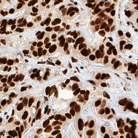 Ku80/XRCC5 antibody in Human Breast Cancer Tissue by Immunohistochemistry (IHC-P).