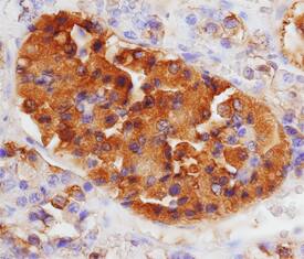 LH beta antibody in Human Pituitary Adenoma by Immunohistochemistry (IHC-P).