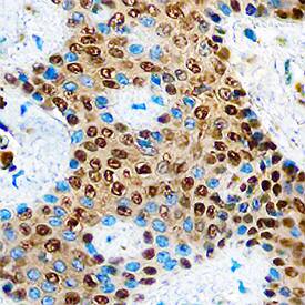 LIMD1 antibody in Human Breast Cancer Tissue by Immunohistochemistry (IHC-P).