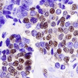 LKB1/STK11 antibody in Human Breast Cancer Tissue by Immunohistochemistry (IHC-P).