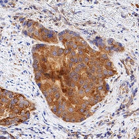 LPAR1/LPA1/EDG-2 antibody in Human Prostate Cancer Tissue by Immunohistochemistry (IHC-P).