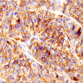 MCAM/CD146 antibody in Human Melanoma Tissue by Immunohistochemistry (IHC-P).