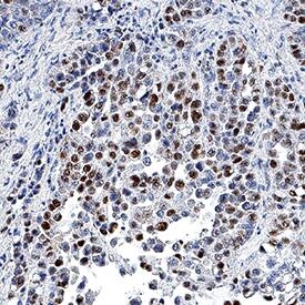 MCM7 antibody in Human Mesothelioma Tissue by Immunohistochemistry (IHC-P).