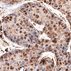 MERIT40 antibody in Human Breast Cancer Tissue by Immunohistochemistry (IHC-P).