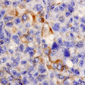 MIA antibody in Human Melanoma by Immunohistochemistry (IHC-P).