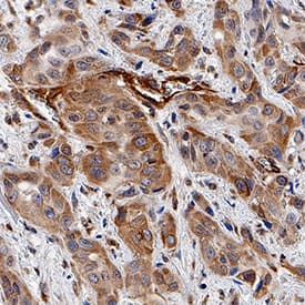 Phospho-MLKL (T357) antibody in Human Squamous Cell Carcinoma by Immunohistochemistry (IHC-P).