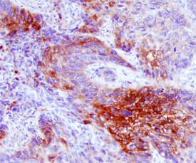 MMP-12 antibody in Human Squamous Cell Carcinoma by Immunohistochemistry (IHC-P).