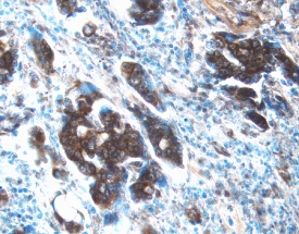 MMP-13 antibody in Human Ovarian Cancer Tissue by Immunohistochemistry (IHC-P).