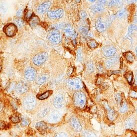MMP-19 antibody in Human Melanoma by Immunohistochemistry (IHC-P).