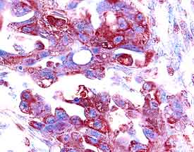 MMP-1 antibody in Human Ovarian Cancer Tissue by Immunohistochemistry (IHC-P).