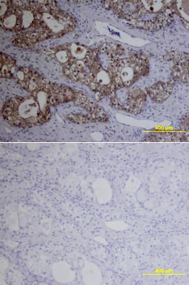 MMP-1 antibody in Human Ovarian Array by Immunohistochemistry (IHC-P).