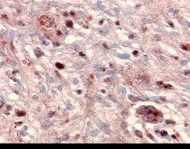 MMP-24 antibody in Human Astro-cytoma by Immunohistochemistry (IHC-P).