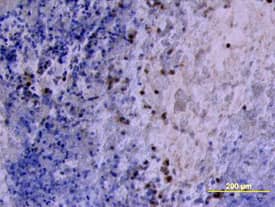 MMP-2 antibody in Human Ovarian Cancer Tissue by Immunohistochemistry (IHC-P).