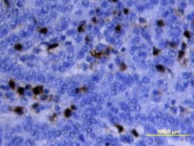 MMP-9 antibody in Human Ovarian Cancer Tissue by Immunohistochemistry (IHC-P).