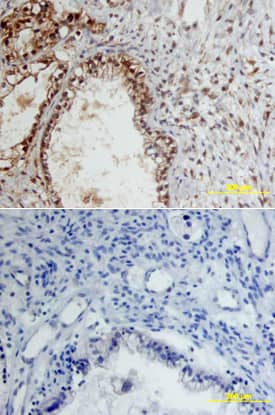MMP-9 antibody in Human Ovarian Cancer Tissue by Immunohistochemistry (IHC-P).