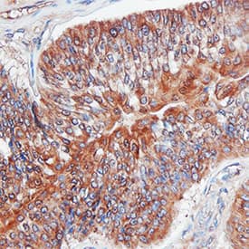 MMP-3 antibody in Human Bladder Cancer Tissue by Immunohistochemistry (IHC-P).