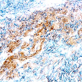 MMP-3 antibody in Human Lung Cancer by Immunohistochemistry (IHC-P).