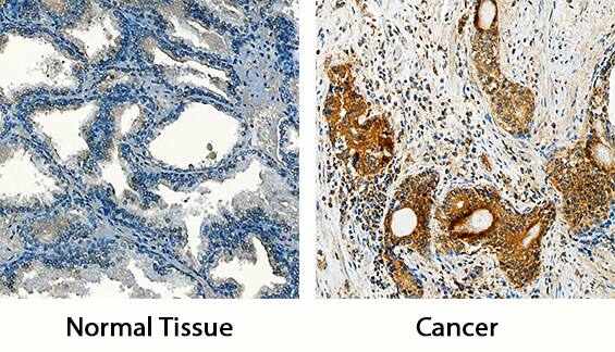 MMP-3 antibody in Human Prostate and Human Prostate Cancer Tissue by Immunohistochemistry (IHC-P).