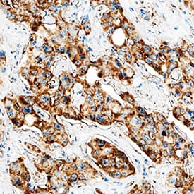 MMP-9 antibody in Human Liver Cancer Tissue by Immunohistochemistry (IHC-P).