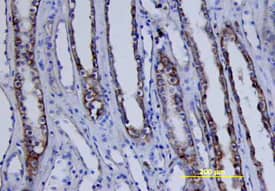 MSK1 antibody in Human Kidney Cancer Tissue by Immunohistochemistry (IHC-P).