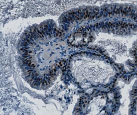 MSX1 antibody in Human Ovarian Cancer Tissue by Immunohistochemistry (IHC-P).