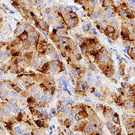 MUC-1 antibody in Human Breast Cancer Tissue by Immunohistochemistry (IHC-P).